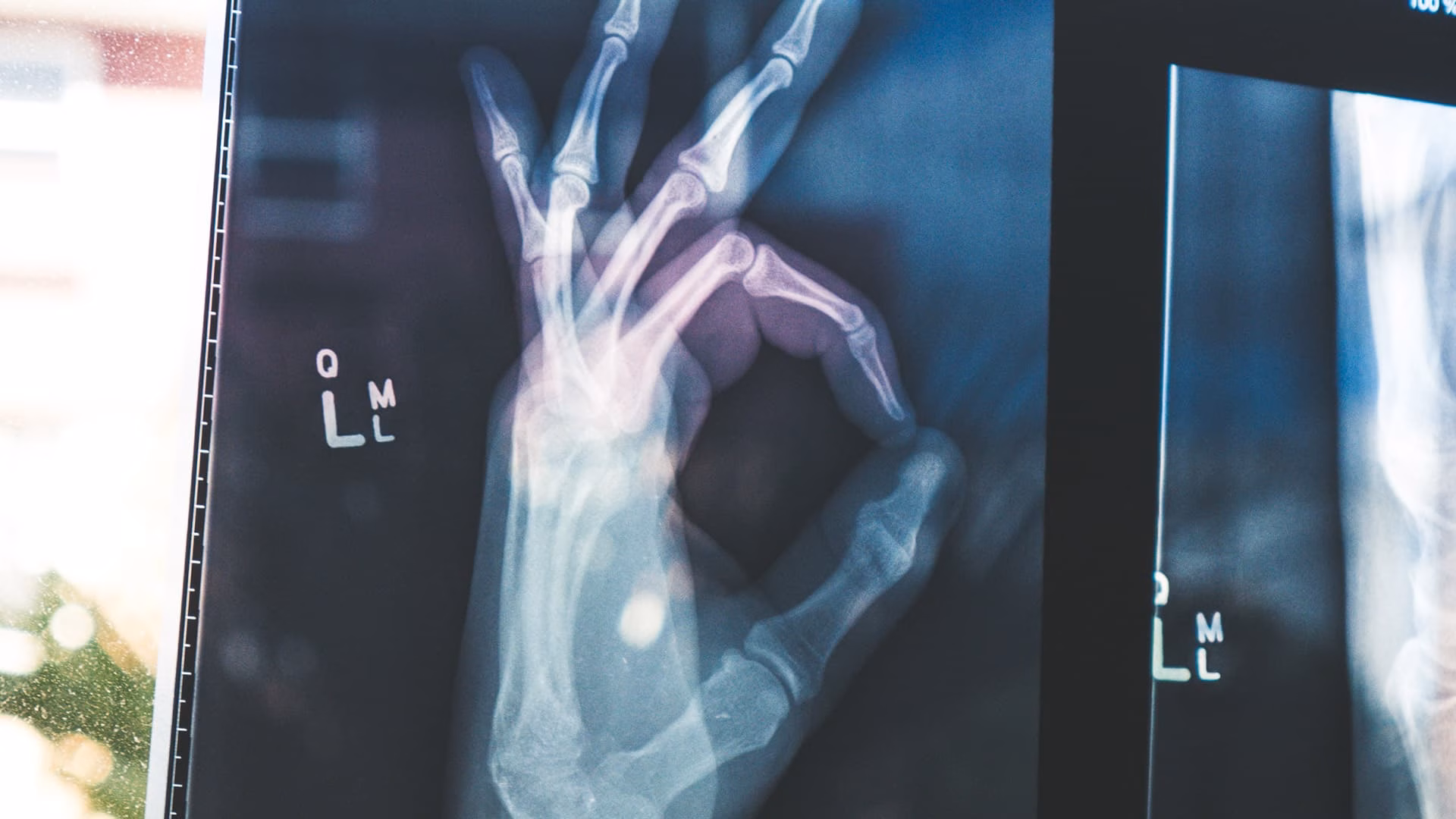 Een röntgenfoto van een hand.